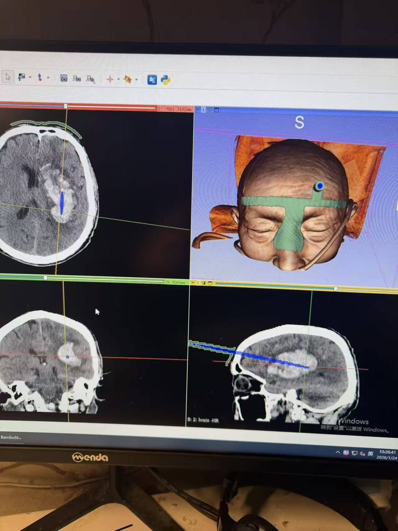 我院神经外科成功开展3D打印微创颅内穿刺抽吸血肿术